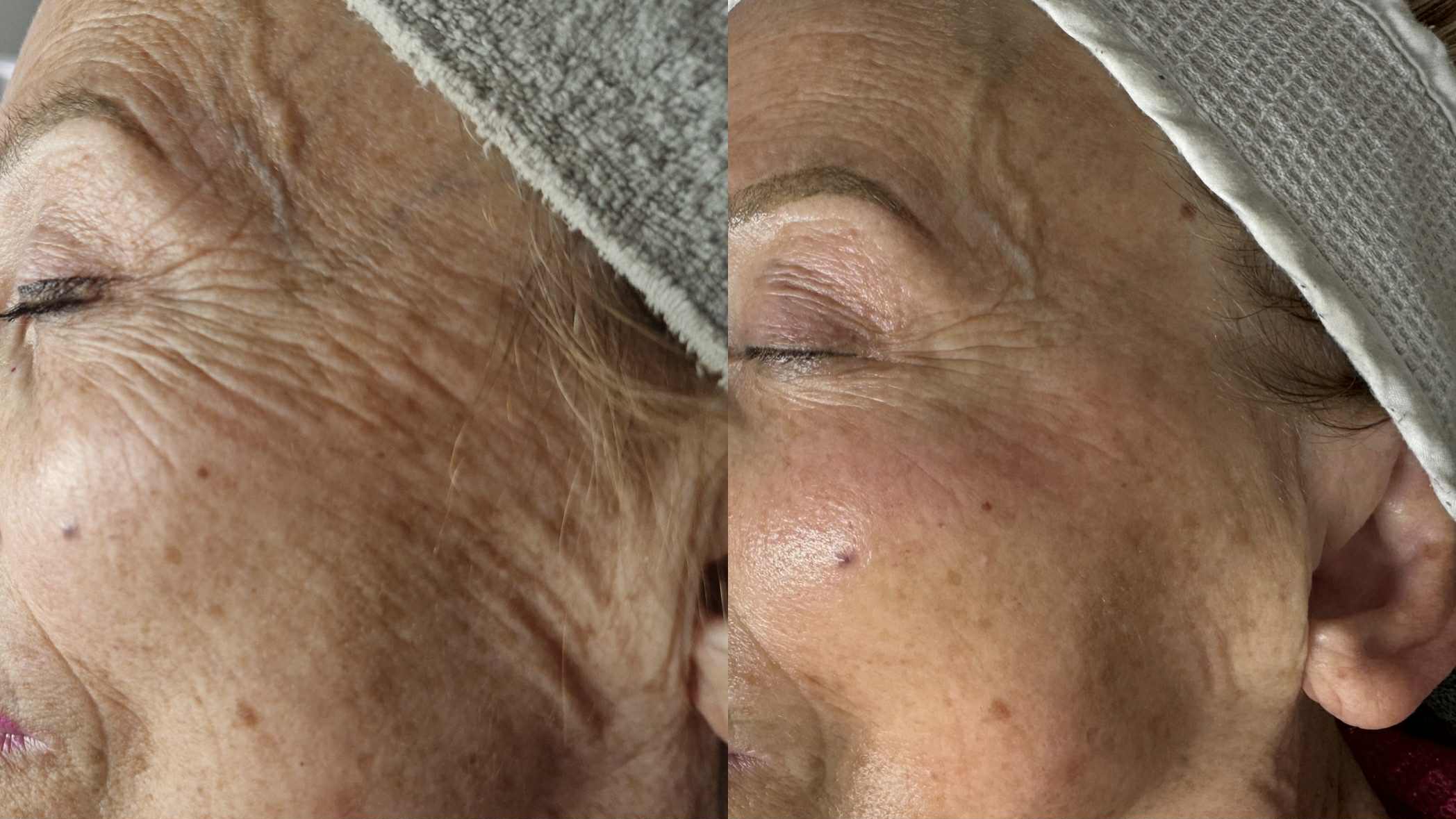 Behandeling tripollar